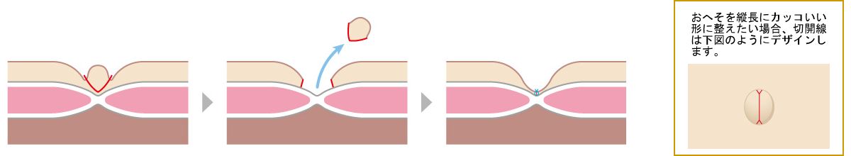 ヘルニアを伴わない単なるデベソ