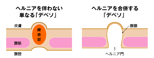 でべその種類・ヘルニア