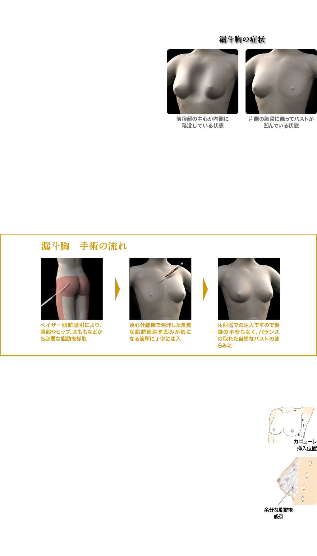 漏斗（ろうと）胸／女性化乳房